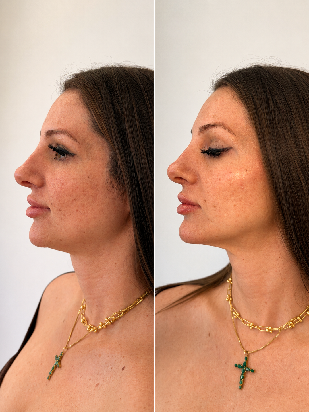 Resultado de contorno facial na Clínica Vitória Oliveira