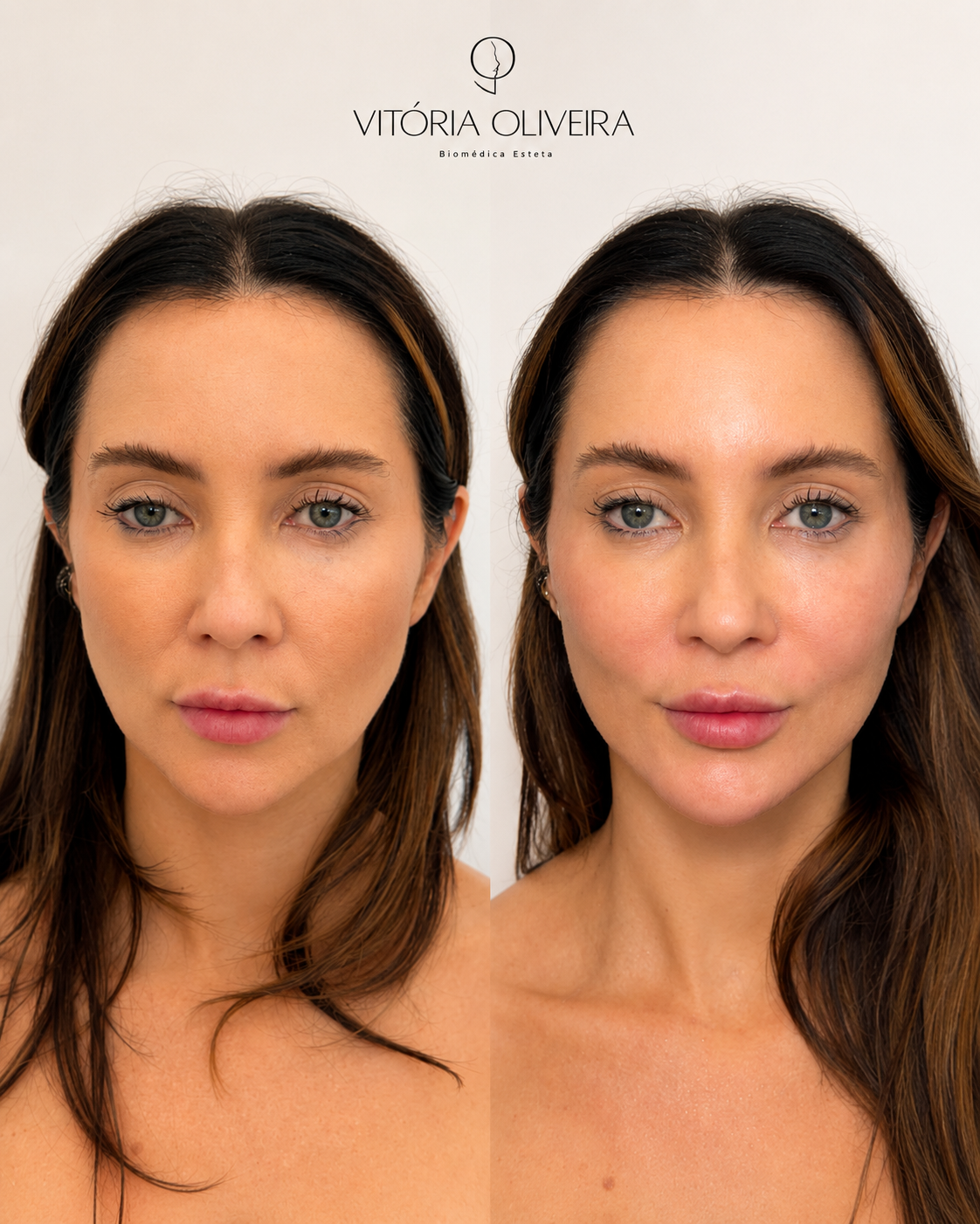 Resultado de estética facial na Clínica Vitória Oliveira