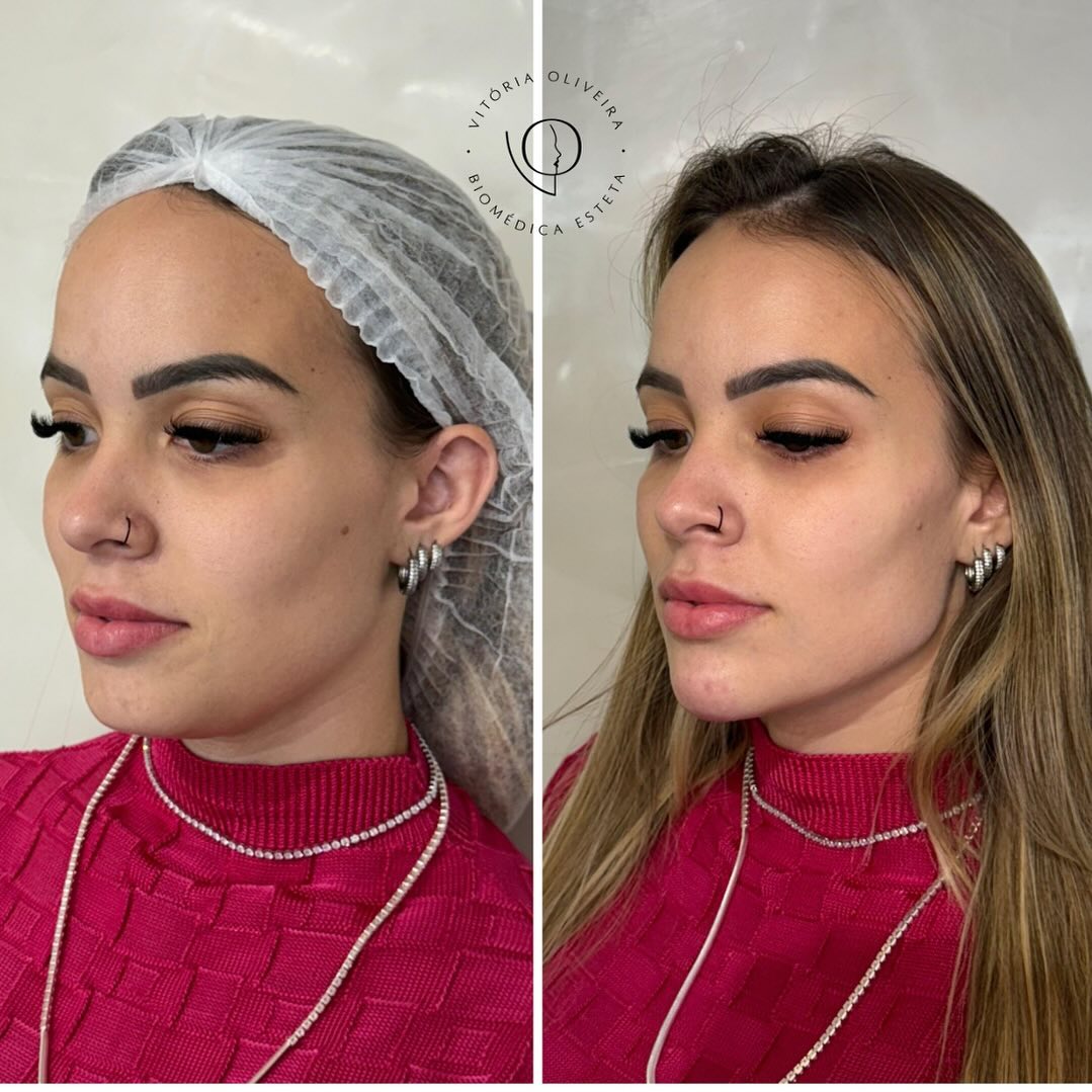 Resultado de harmonização facial na Clínica Vitória Oliveira