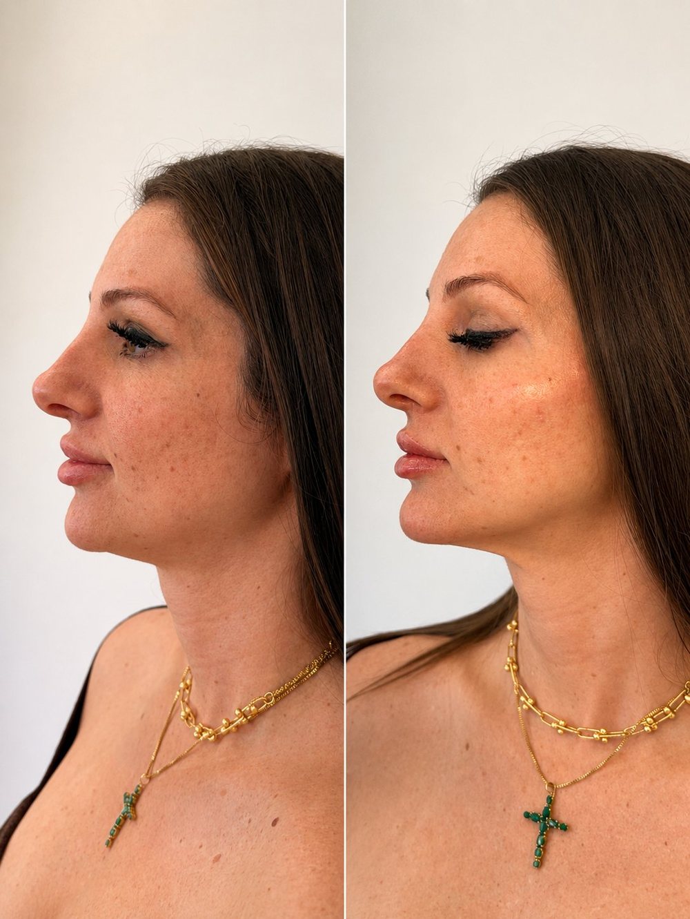 Resultado de contorno facial na Clínica Vitória Oliveira