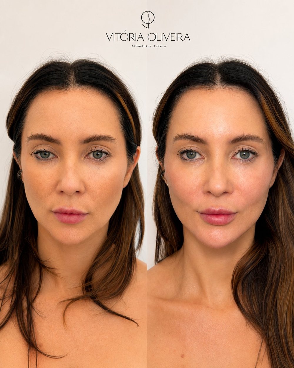 Resultado de harmonização facial na Clínica Vitória Oliveira